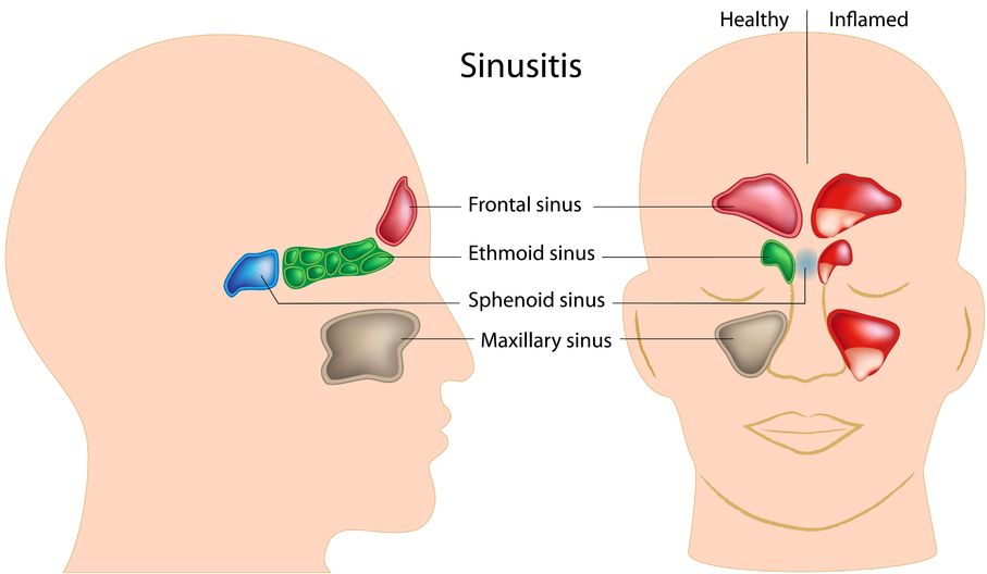 Sinusitis - Enfoques Integrativos